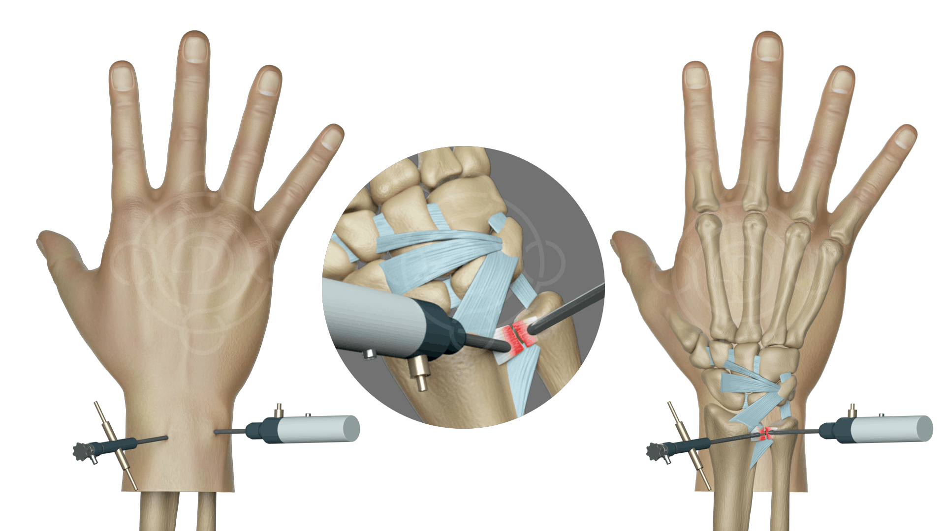 El bilek ve dirsek artroskopik (kapalı sistem)