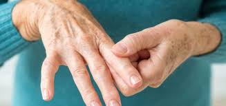 Romatoid Artrit Nedir? Romatoid Artrit Belirtileri ve Tedavisi